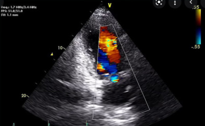 Echocardiogram